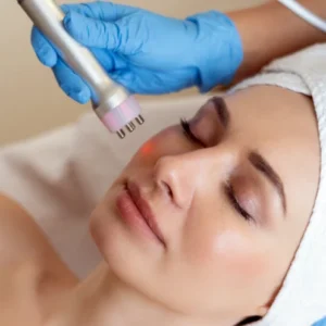 Radiofrecuencia facial